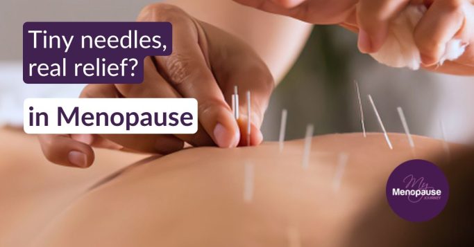 Relaxed midlife woman during an acupuncture for menopause session
