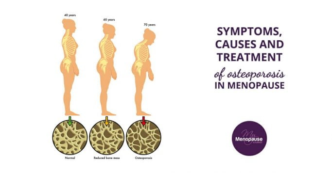 Symptoms, Causes and Treatment of Osteoporosis in Menopause